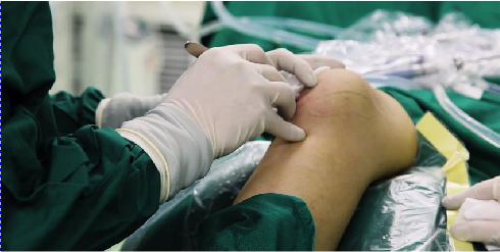 中醫(yī)微(wēi)創可(kě)視(shì)針刀(dāo)鏡技(jì)術(shù)