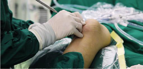 中醫(yī)微(wēi)創可(kě)視(shì)針刀(dāo)鏡技(jì)術(shù)