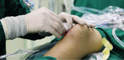 中醫(yī)微(wēi)創可(kě)視(shì)針刀(dāo)鏡技(jì)術(shù)