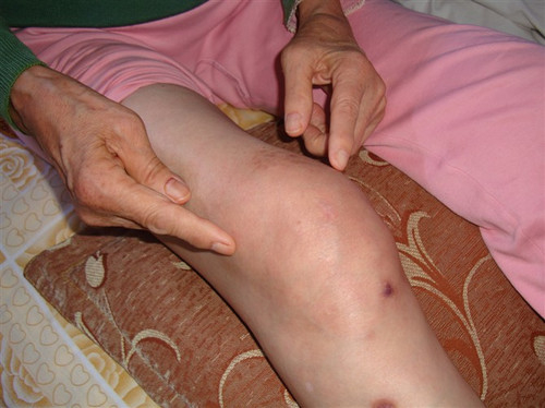 風(fēng)濕性關節炎不(bù)治療有(yǒu)什(shén)麽危害嗎(ma)