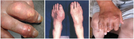 慢(màn)性痛風(fēng)病具體(tǐ)有(yǒu)哪些(xiē)危害?