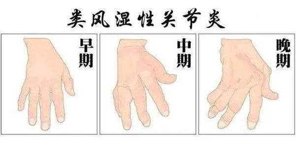 類風(fēng)濕性關節炎是(shì)不(bù)是(shì)會(huì)晨僵?主要(yào)晨僵表現(xiàn)有(yǒu)哪些(xiē)?
