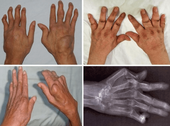 重慶類風(fēng)濕：從(cóng)疼痛特點判斷是(shì)否是(shì)類風(fēng)濕性關節炎