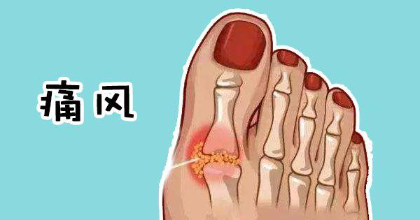 痛風(fēng)常見(jiàn)的(de)治手段都(dōu)有(yǒu)哪些(xiē)