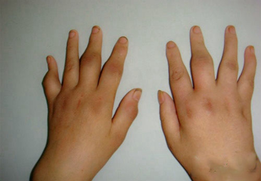 類風(fēng)濕有(yǒu)哪些(xiē)症狀表現(xiàn)