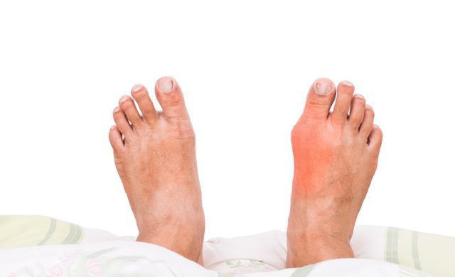 怎麽判斷自(zì)己得(de)了(le)痛風(fēng)